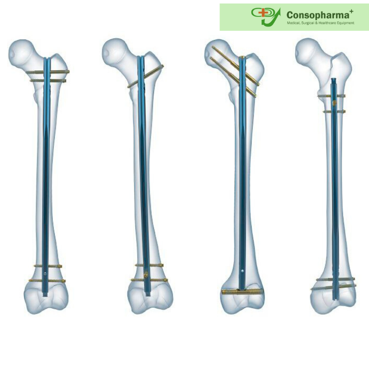 A Brief Overview Of Intramedullary Nailing Consopharma
